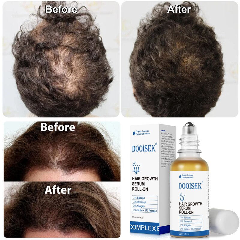 Hair Growth Serum Manufacturer - Factory Roll-on with 3% Rosemary & Redensyl