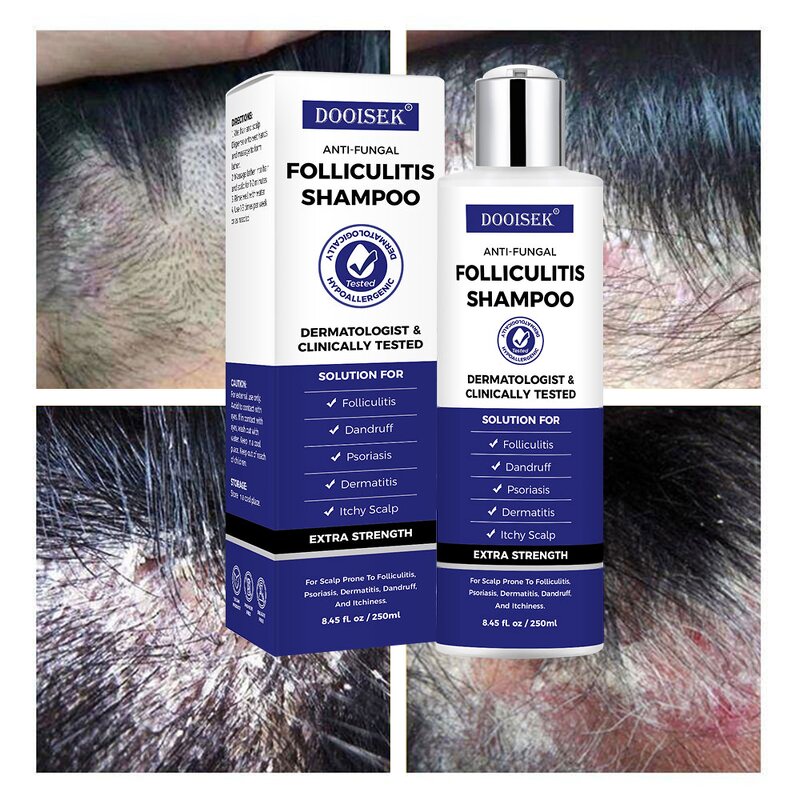 Anti-Dandruff Shampoo Manufacturer - Deep Cleaning for Folliculitis & Psoriasis