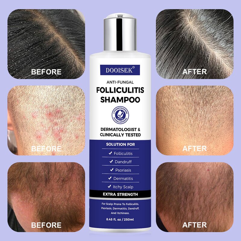 Anti-Dandruff Shampoo Manufacturer - Nutrient-Packed Herbal Blend Hydrates Scalp