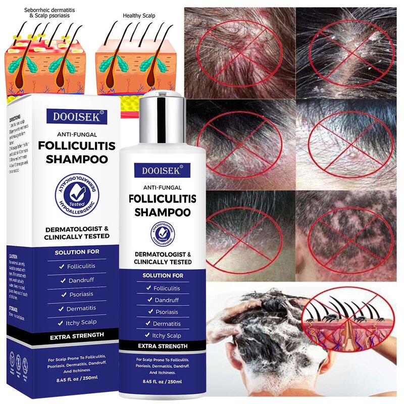 Anti-Fungal Shampoo Manufacturer - Hot Sale for Itchy Dry Scalp & Folliculitis