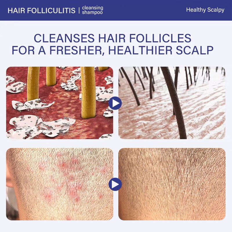 Antifungal Shampoo Manufacturer - Customize with Salicylic Acid & Tea Tree Oil