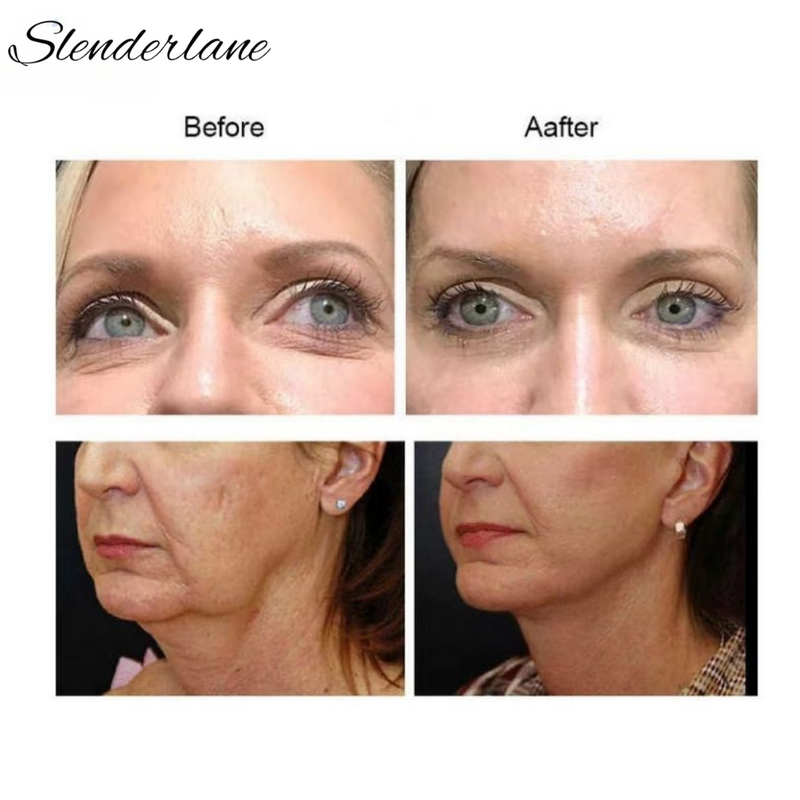 PDO Thread Manufacturer - Korean Big V Line 18g100mm L Blunt Cannula 6D COG