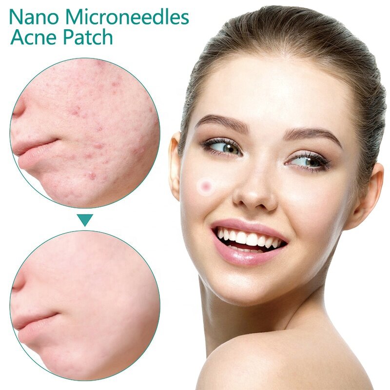 Acne Patches Manufacturer - Hydrocolloid for Early Stage Treatment & Custom Pimple Patch