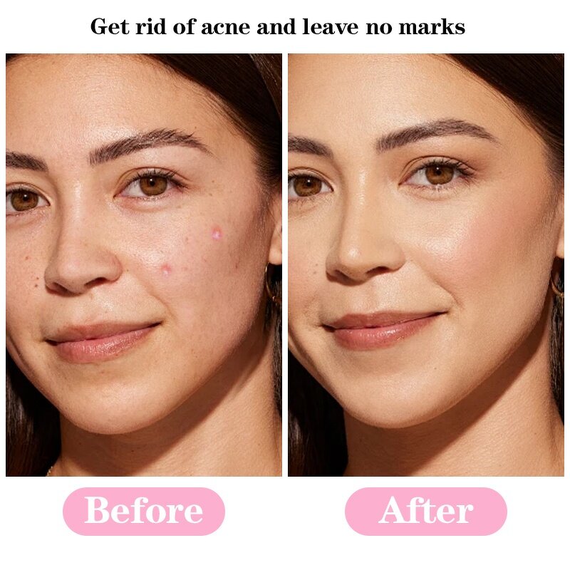 Pimple Patches Manufacturer - Private Label Cute Cartoon Hydrocolloid 36-Piece for Acne