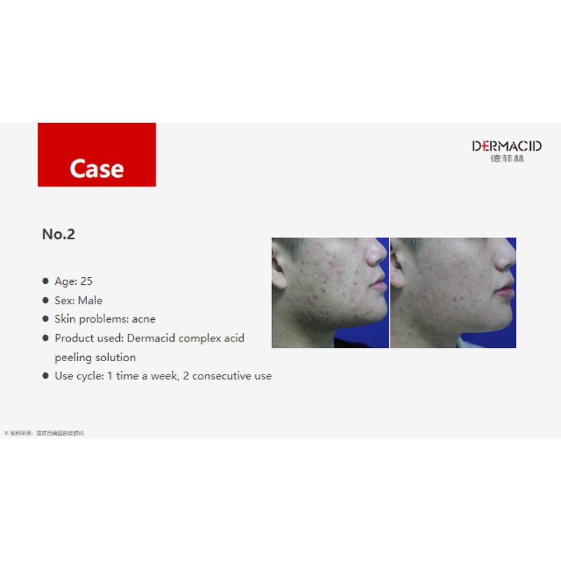 Chemical Peeling Manufacturer - 5g*10tubes 35% Compound Acids for Acne Pigmentation & Private Label