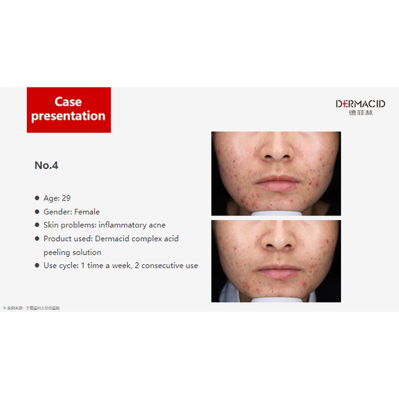 Chemical Peeling Manufacturer - 5g*10tubes 35% Compound Acids for Acne Pigmentation & Private Label