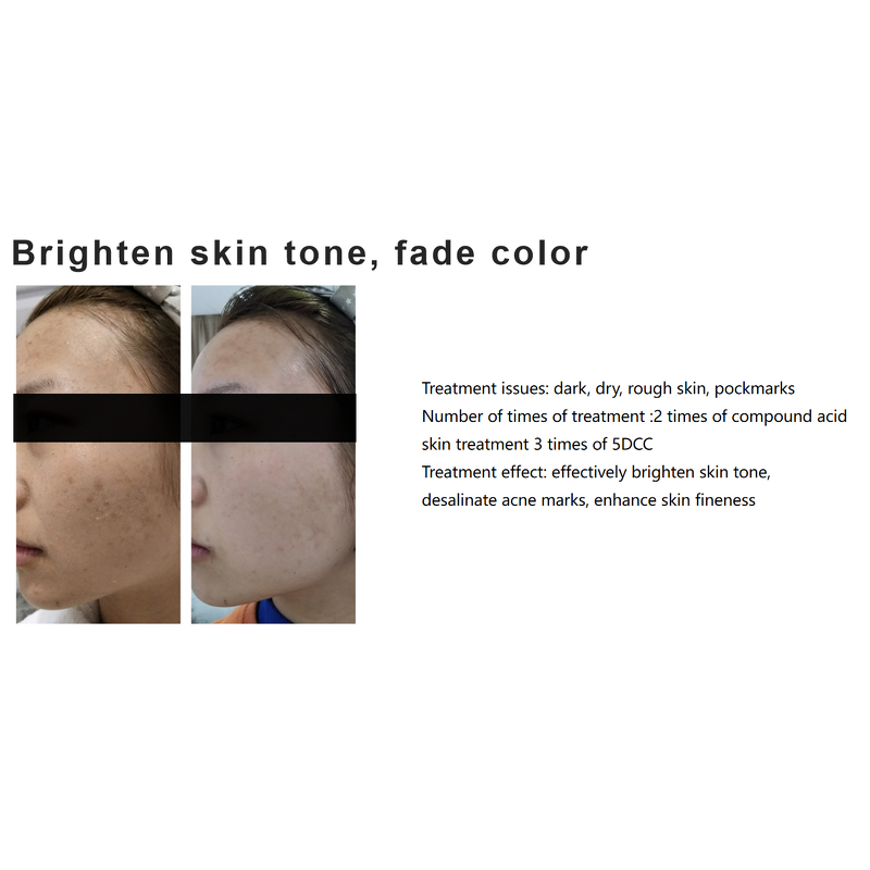 Skin Booster Serum Manufacturer - 3ML*5 Whitening Anti Acne Pigmentation Hyaluronic Acid & Private Label