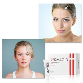Chemical Peeling Gel Manufacturer - 35% Compound Acid for Anti Acne Pigmentation & Professional