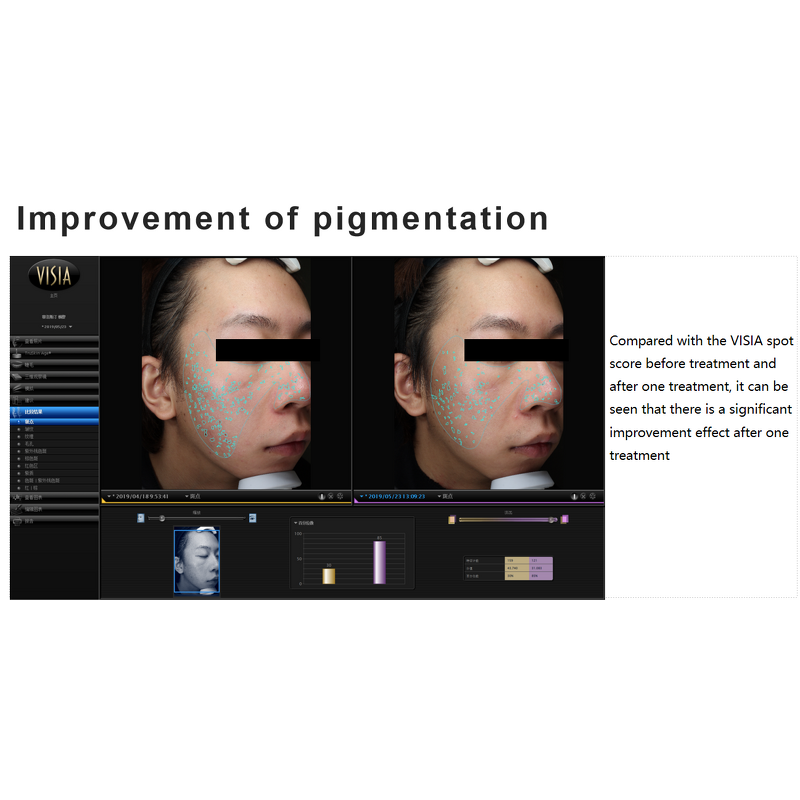 Skin Booster Serum Manufacturer - 3ML*5 Whitening Anti Acne Pigmentation Hyaluronic Acid & Private Label