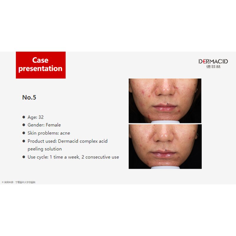 Chemical Peeling Gel Manufacturer - 35% Mandelic Acid Salicylic Acid for Acne Aging Spots & OEM