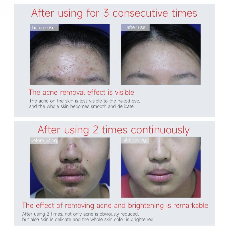Chemical Peeling Gel Manufacturer - 35% Compound Acid for Anti Acne Pigmentation & Professional