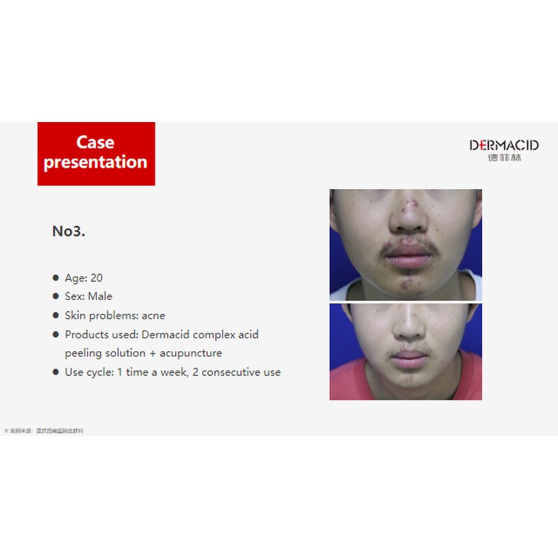 Chemical Peeling Solution Manufacturer - for Spot Pigmentation Removal Melasma Dull Skin & Wholesale