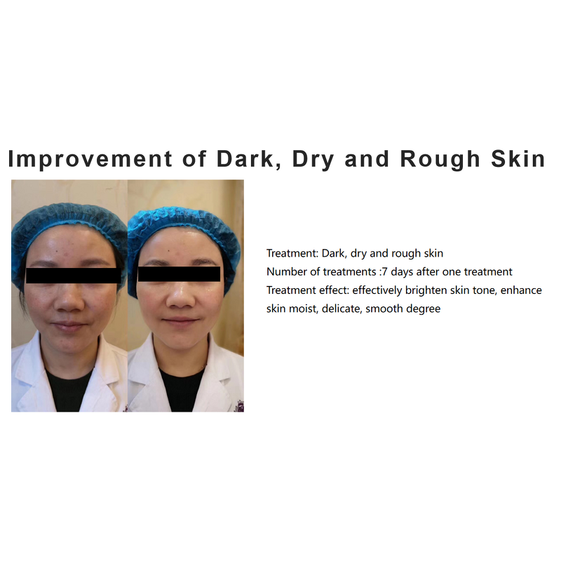 Skin Booster Serum Manufacturer - 3ML*5 Whitening Anti Acne Pigmentation Hyaluronic Acid & Private Label