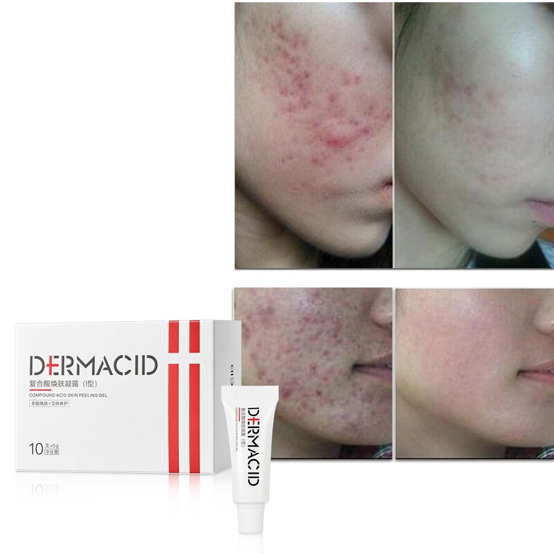 Chemical Peels Gel Manufacturer - 35% Compound Acid for Acne Removing & JUYOU Wholesale