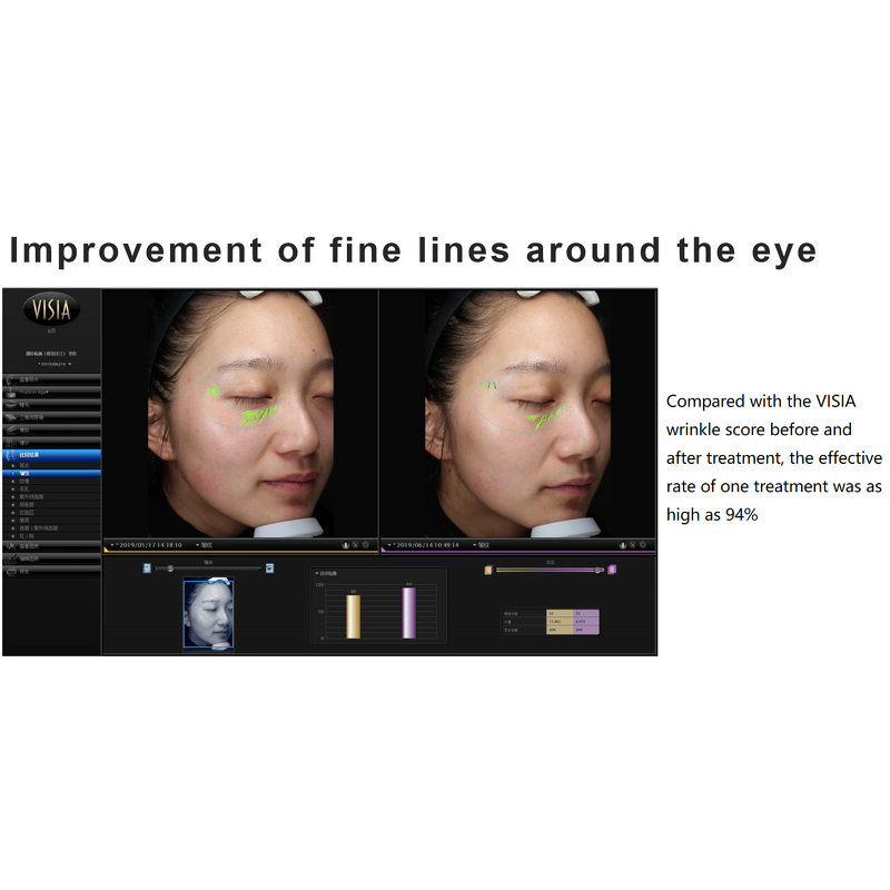 Mesotherapy Serum Manufacturer - 3ml*5 Hyaluronic Acid Anti Wrinkle Fines Acnes & Private Label