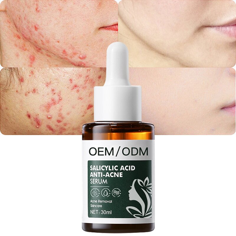 Salicylic Acid Serum Manufacturer - OEM Private Label Anti-Acne Pore Refresher Peeling