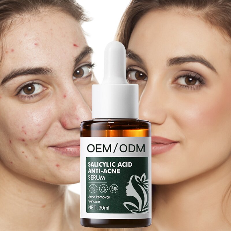 Salicylic Acid Serum Manufacturer - OEM Private Label Anti-Acne Pore Refresher Peeling