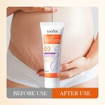 Stretch Mark Removal Cream