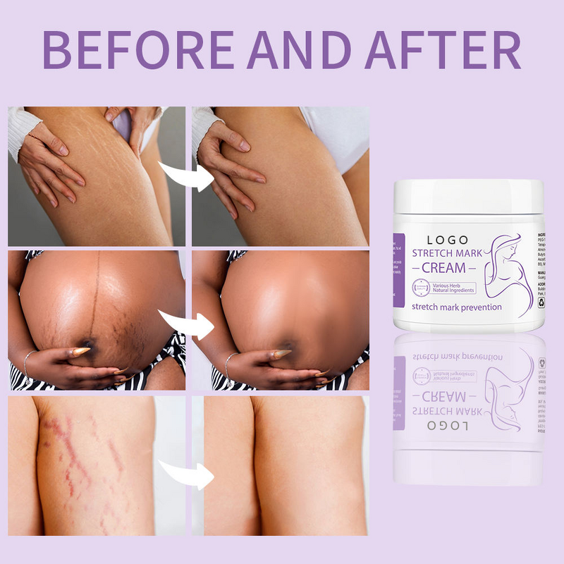 Scar Removal Cream Manufacturer - Organic Vegan for Stretch Mark with Shea Butter & Private Label