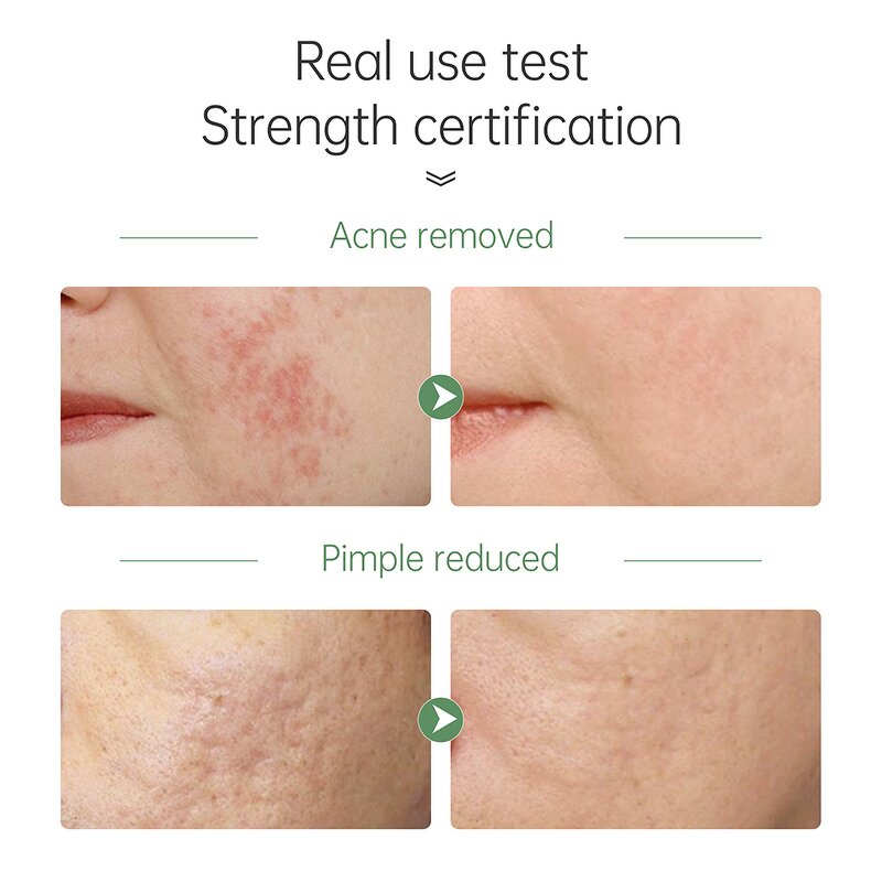 Tea Tree Face Wash - JoyPretty Private Label Deep Cleansning Pore Moisturizing Oil Control