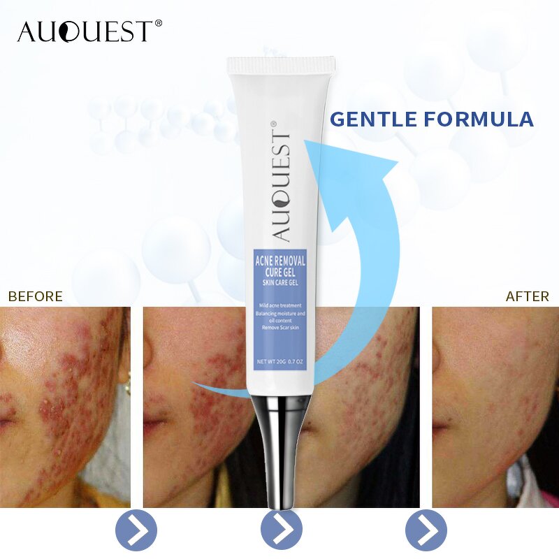 Acne Removal Cream Gel - Stretch Marks Desalt Quick Effective No Side Effects