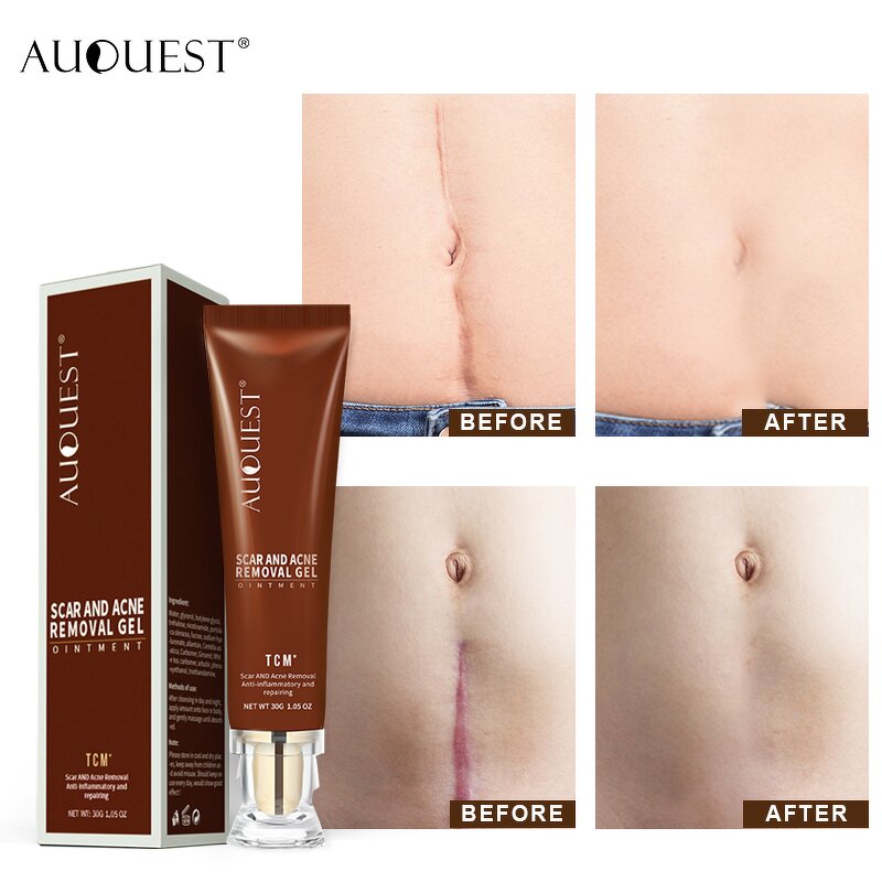 TCM Scar Repair Gel - Wholesale Acne Mark Removal Stretch Mark Skin Treatment