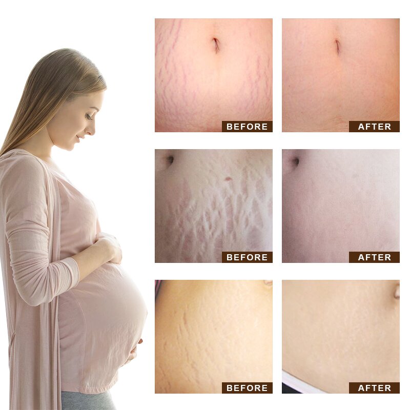 TCM Scar Repair Gel - Wholesale Acne Mark Removal Stretch Mark Skin Treatment