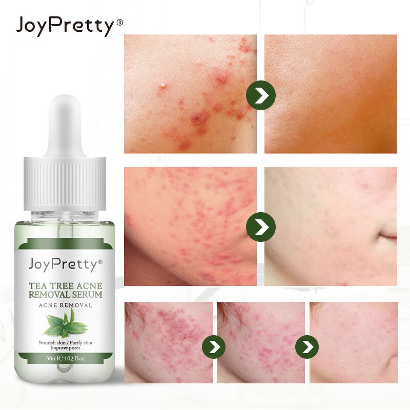 Tea Tree Acne Serum - JoyPretty Natural Organic Moisturizing Whitening Dark Spot Remover