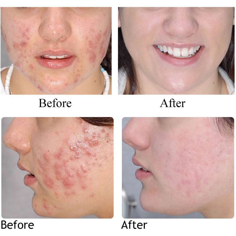 Acne Facial Serum - OEM Private Label Organic Skin Care Pimple Smoothing Liquid