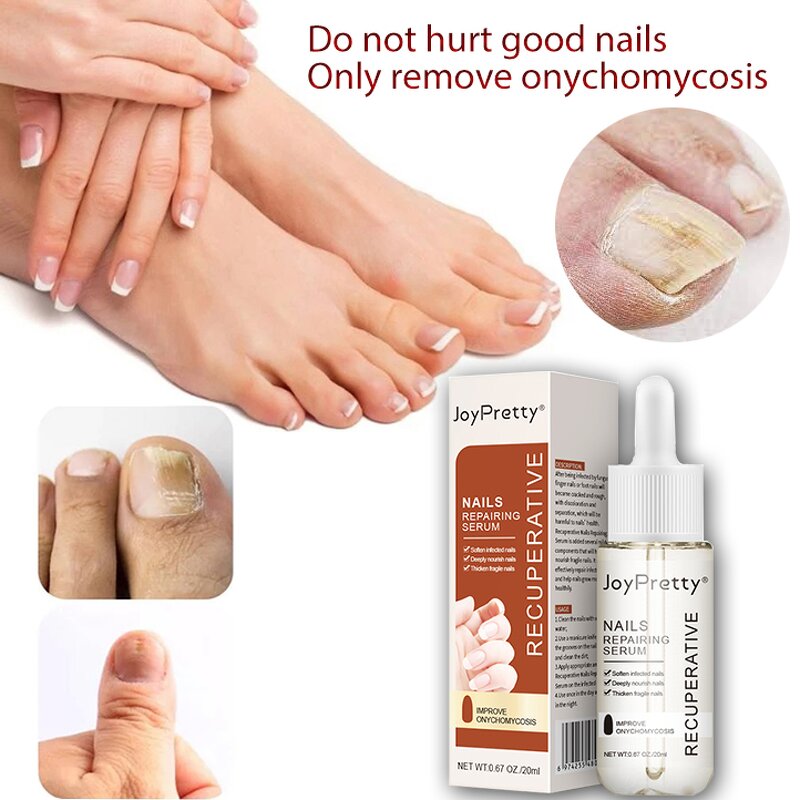 Toe Nail Fungus Gel - Fungal Treatment Whitening Anti Infection Foot Repair Liquid