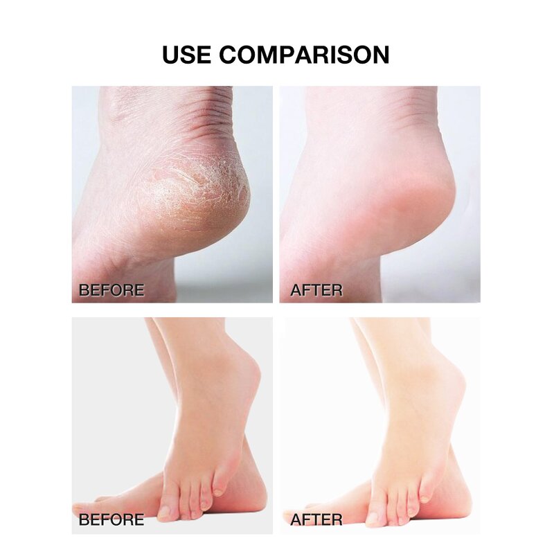 Urea Foot Cream - Private Label 40% Whitening Repair Moisturizing Peel Crack Heel Care