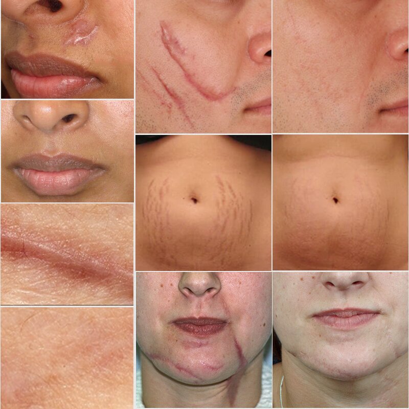 TCM Scar Repair Gel - Wholesale Acne Mark Removal Stretch Mark Skin Treatment