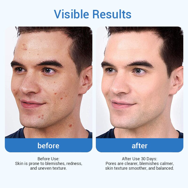 Blemish Relief Serum - Private Label Centella Panthenol Tea Tree 30ml Gentle All Skin Types