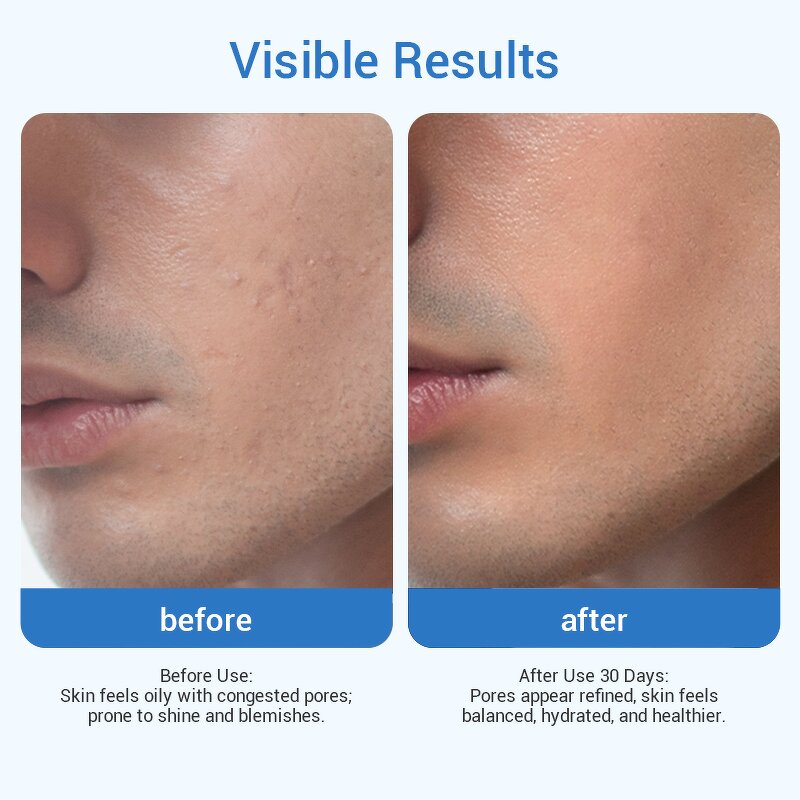 Men's Oil Control Cleanser - Private Label Hyaluronic Acid Charcoal Witch Hazel Reduce Pore