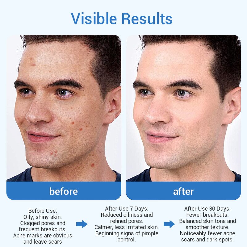 Men Face Care Set - Oil Control Moisturizing Fewer Acne Scars Dark Spots OEM ODM Accept