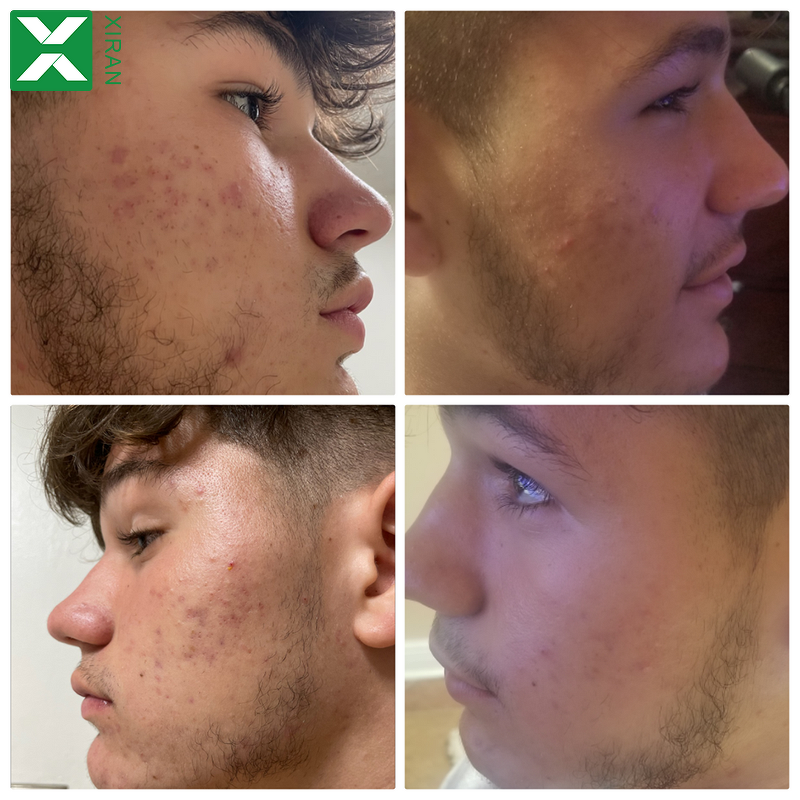 Men Clean Set - Private Label Oil Control Anti-Acne Face Wash Scrub Repairing Lotion