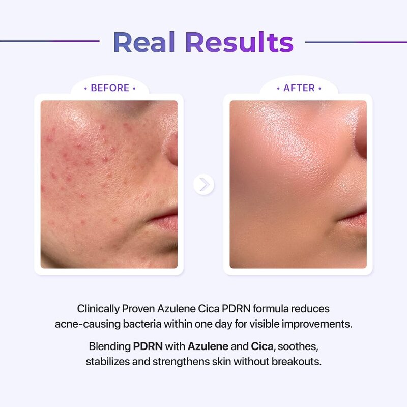 PDRN Fiber Serum - Private Label Azulene Centella Anti Acne Barrier Repair Soothing 30ml