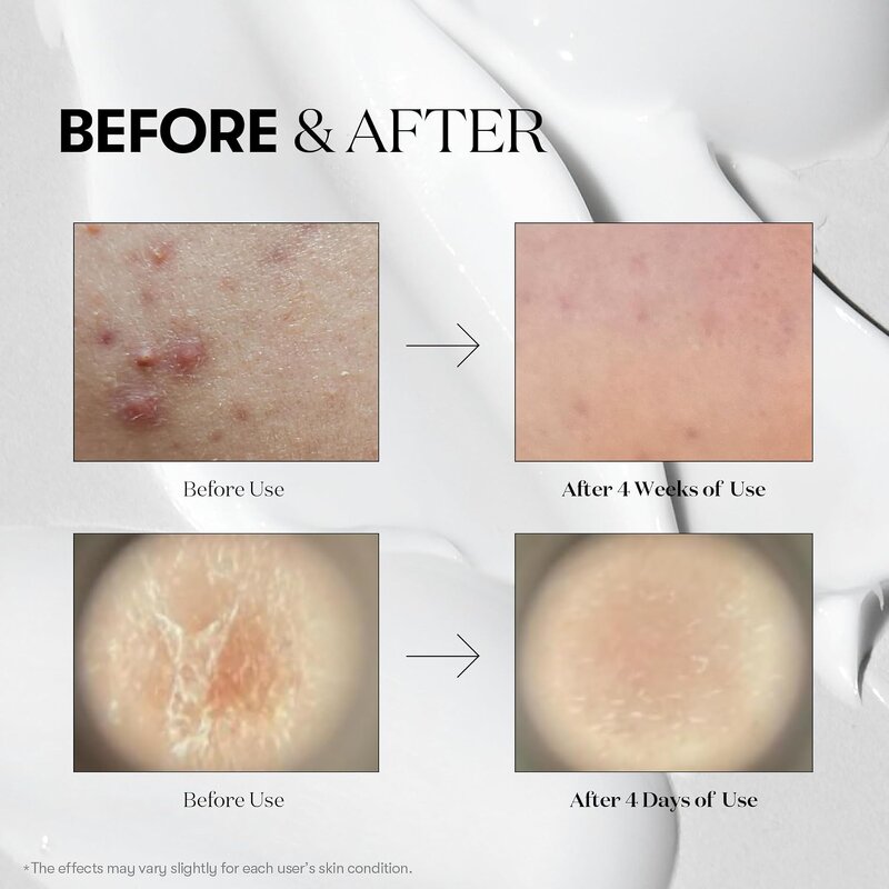 Korean Microneedling Serum - Private Label Reduce Acne Marks Tightening Hyaluronic Acid