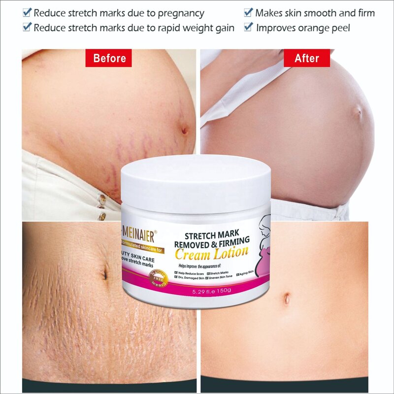 Stretch Mark Repair Cream - Top Selling Postpartum Pregnancy Slimming Anti Aging Cream