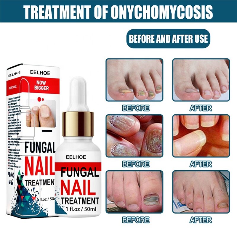 Fungal Nail Destroyer - Best Seller Wholesale Effective Anti-Fungal Finger Toe Nail Repair