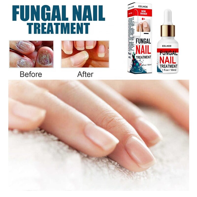 Fungal Nail Destroyer - Best Seller Wholesale Effective Anti-Fungal Finger Toe Nail Repair