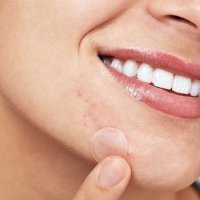 Acne Spot Treatment Supplier - Custom Private Label Microneedling