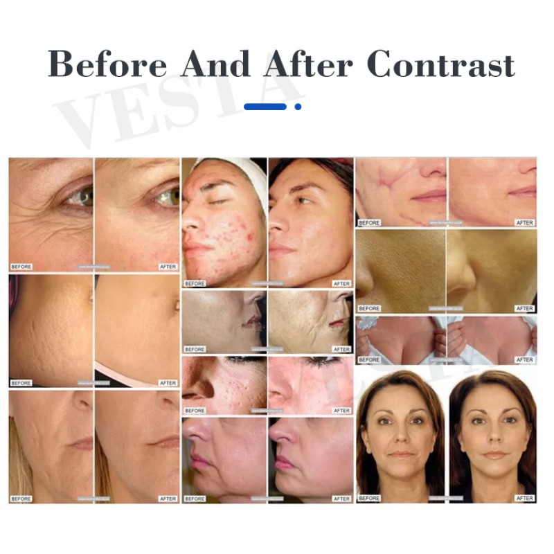 Derma Pen Cartridges Factory - Wholesale Replaceable Micro Needle