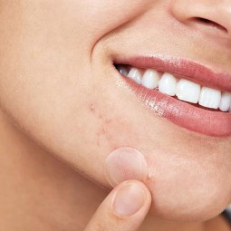 Micro Needle Acne Patches Factory - OEM Transparent Hyaluronic Acid