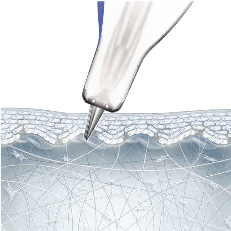 Tinysoft Nanosoft Needle Factory - 3 Pin 34G Hyaluronic Filling