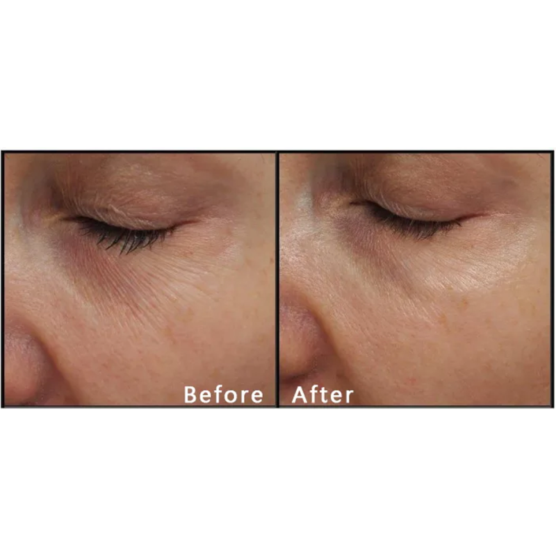 Tinysoft Nanosoft Needle Factory - 3 Pin 34G Hyaluronic Filling