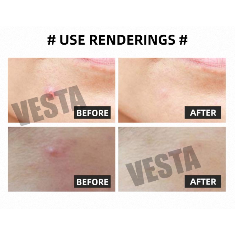 Micro Needle Acne Patches Factory - OEM Transparent Hyaluronic Acid