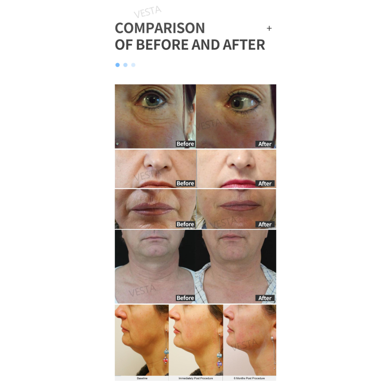 Hydra Machine Solution Manufacturer - Hot Sale Aqua Peel Rejuvenation