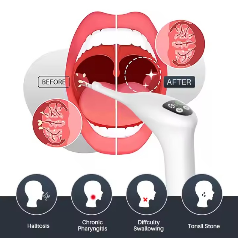 Electric Tonsil Remover Manufacturer - Waterproof 6 Suction Levels