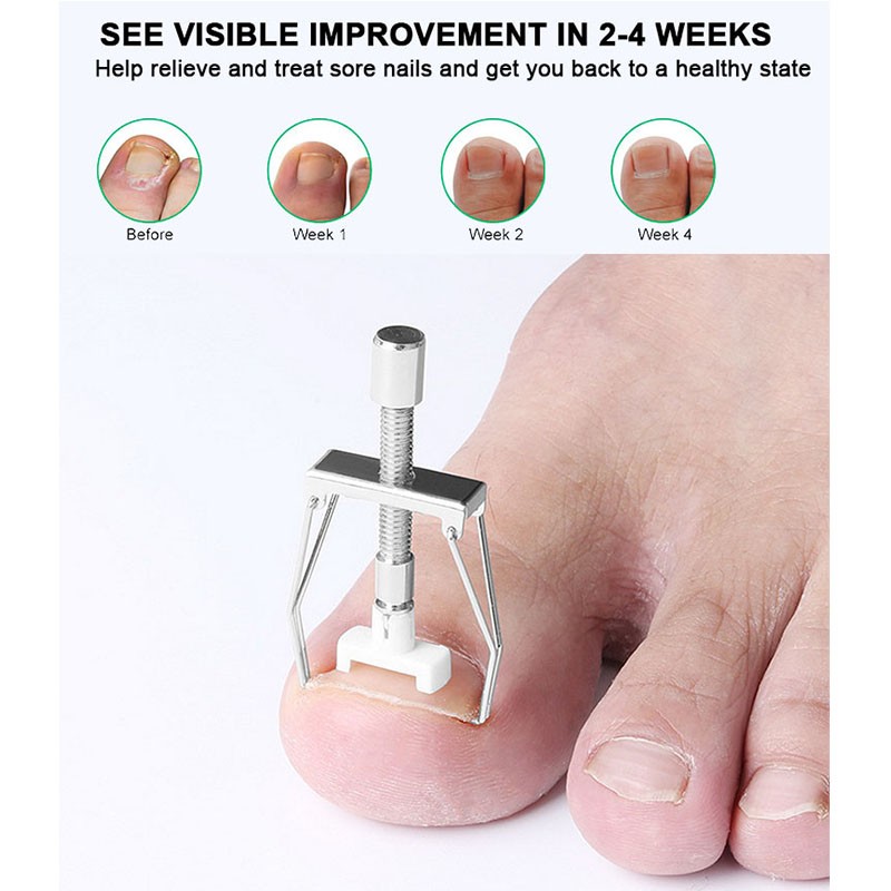 Toenail Corrector Factory - High Quality Stainless Steel